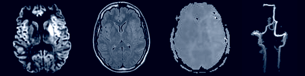 Examples of stroke imaging